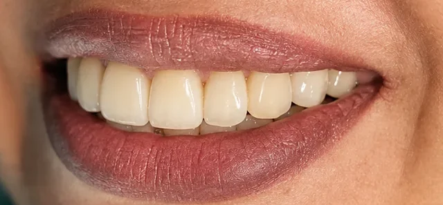 Cosmetic bonding — repairing chips and gaps — after