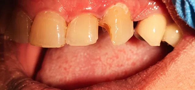 Cosmetic bonding — repairing chips and gaps — before