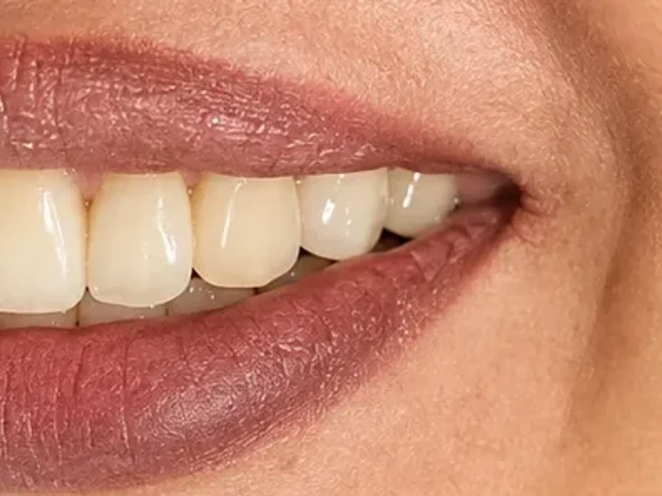 Cosmetic bonding — repairing chips and gaps — after