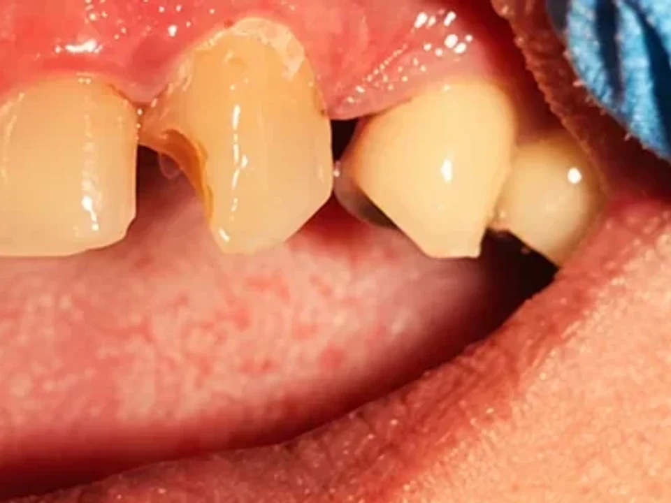 Cosmetic bonding — repairing chips and gaps — before