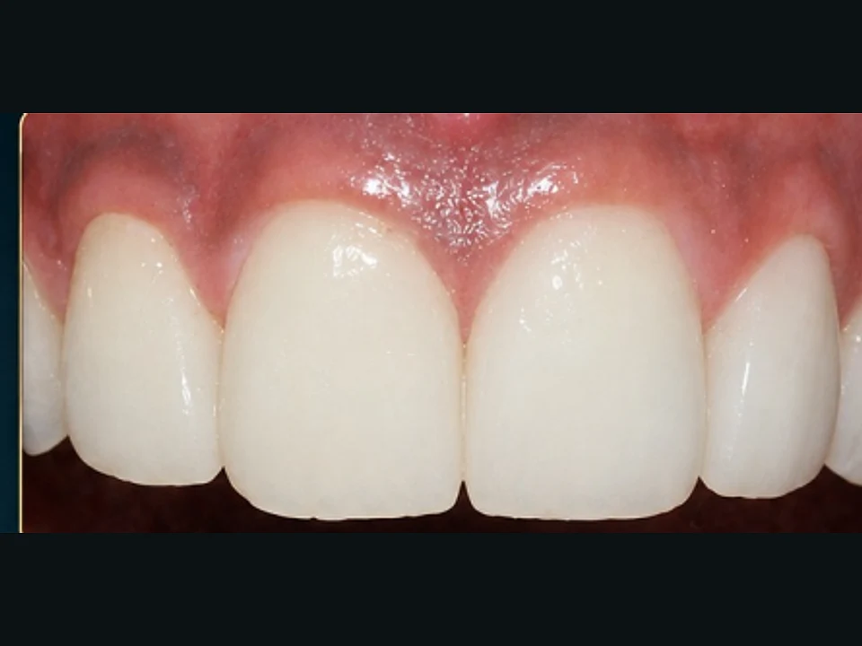 Decayed front teeth rebuilt with tooth-coloured restorations — after
