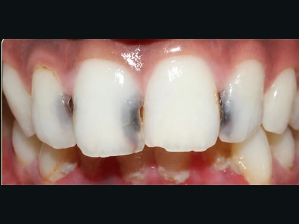 Decayed front teeth rebuilt with tooth-coloured restorations — before