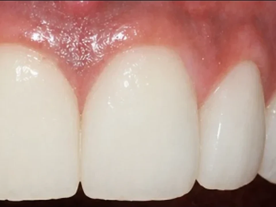 Decayed front teeth rebuilt with tooth-coloured restorations — after