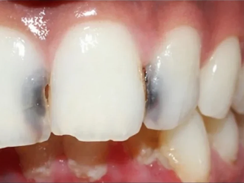Decayed front teeth rebuilt with tooth-coloured restorations — before