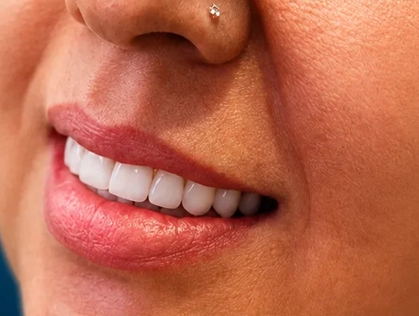 Full mouth reconstruction — bone grafting, sinus grafting and implants — after