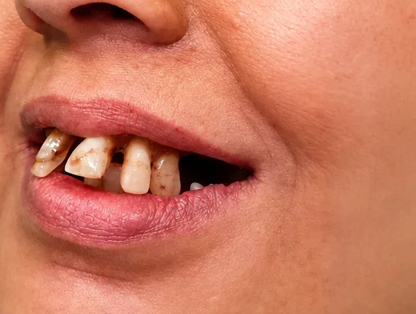 Full mouth reconstruction — bone grafting, sinus grafting and implants — before