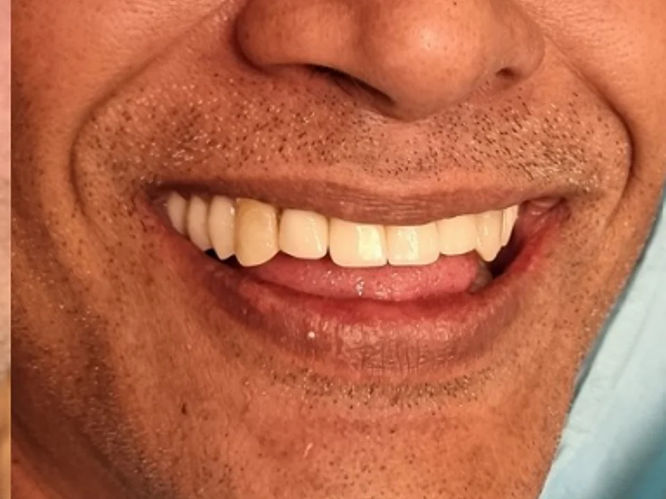 Full mouth restoration — confidence restored — after