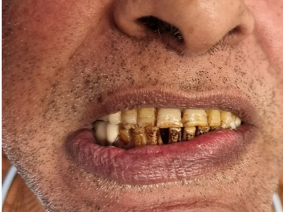 Full mouth restoration — confidence restored — before