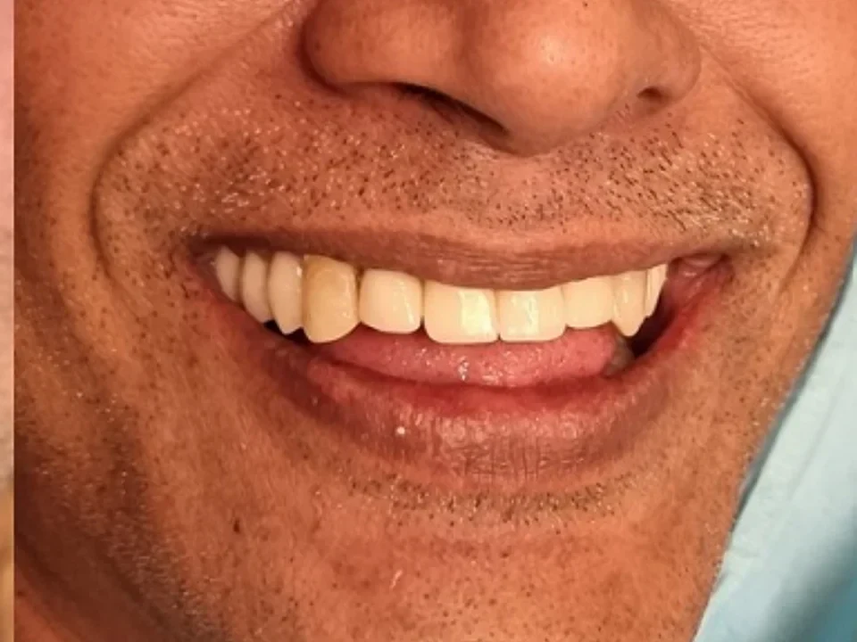 Full mouth restoration — confidence restored — after