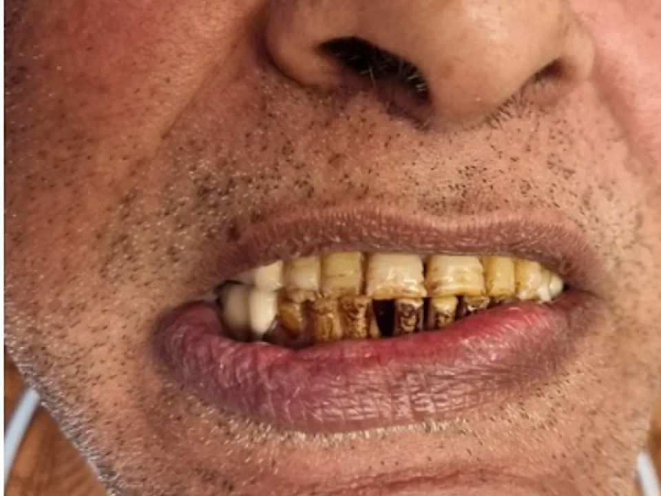 Full mouth restoration — confidence restored — before
