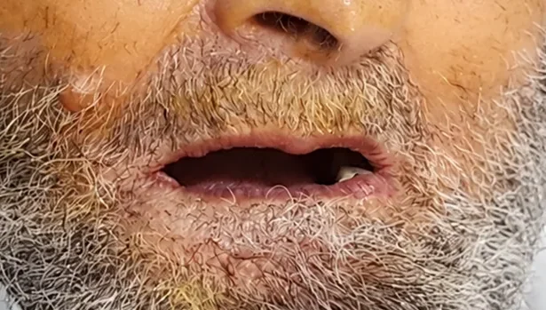 A smile reborn through dental implants — before