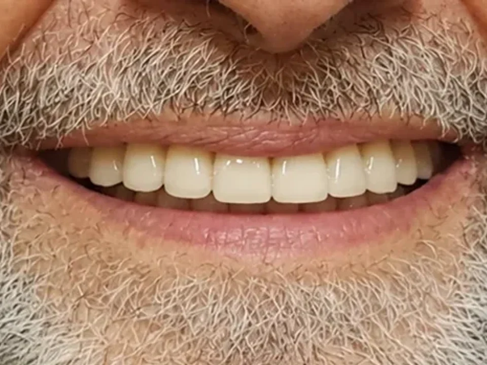 A smile reborn through dental implants — after