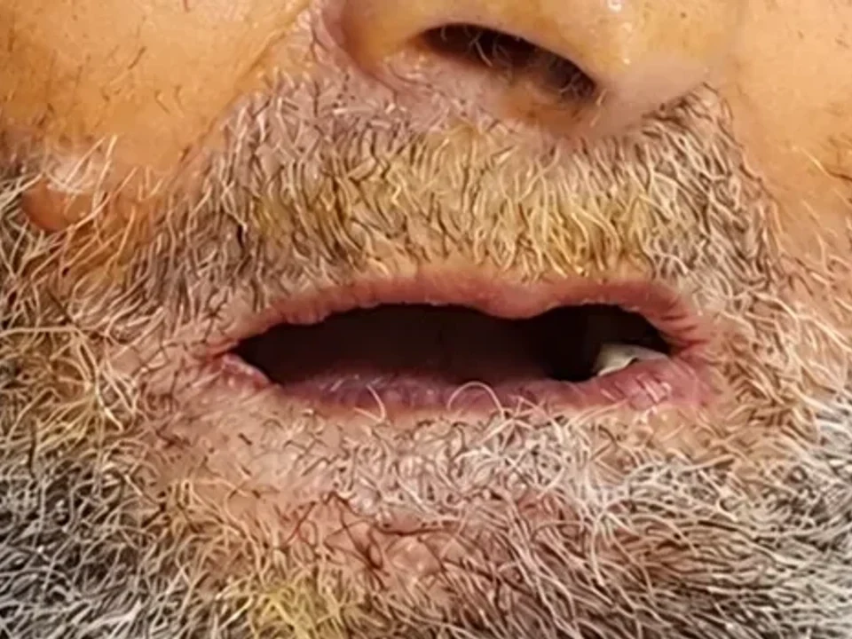 A smile reborn through dental implants — before