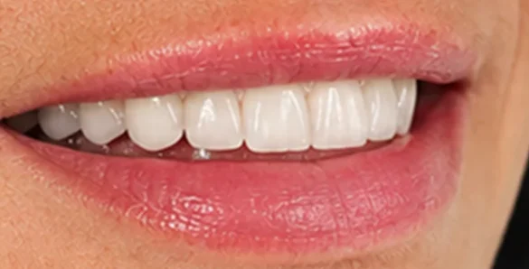 Implant and reconstructive surgery — after