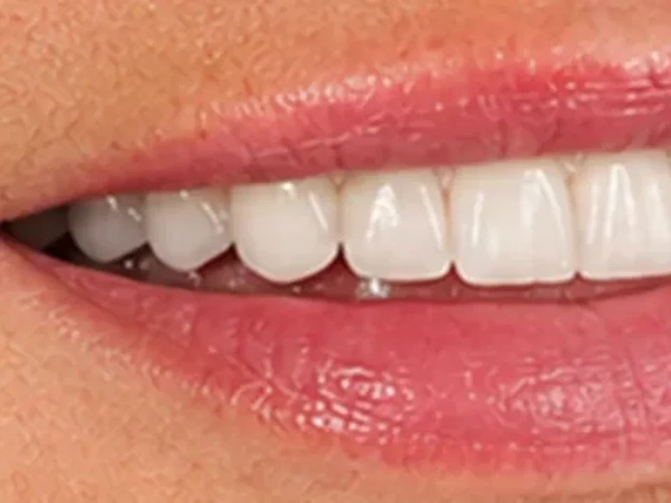 Implant and reconstructive surgery — after