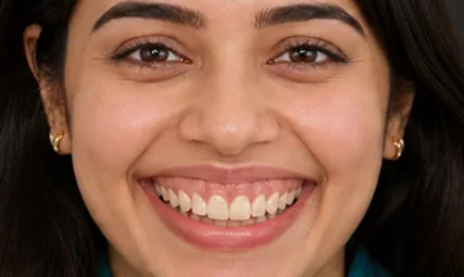 Gum contouring — portrait — before