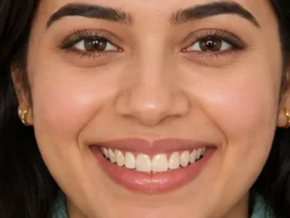 Gum contouring — portrait — after