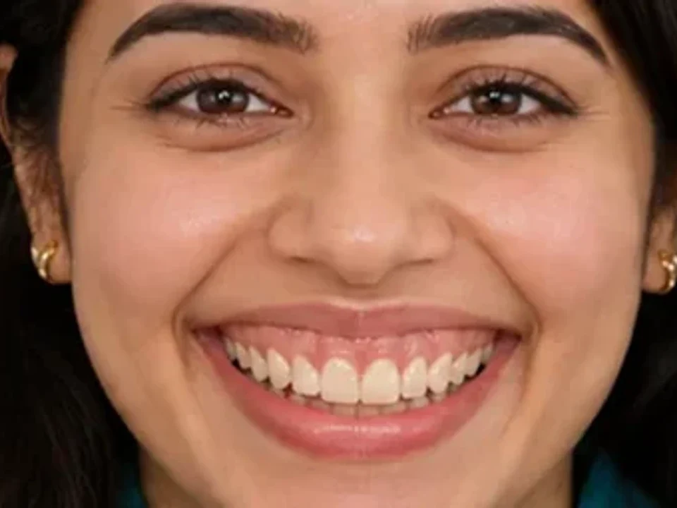 Gum contouring — portrait — before