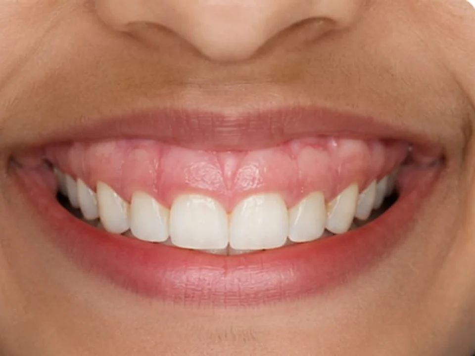Excess gum reshaped for a balanced smile — before