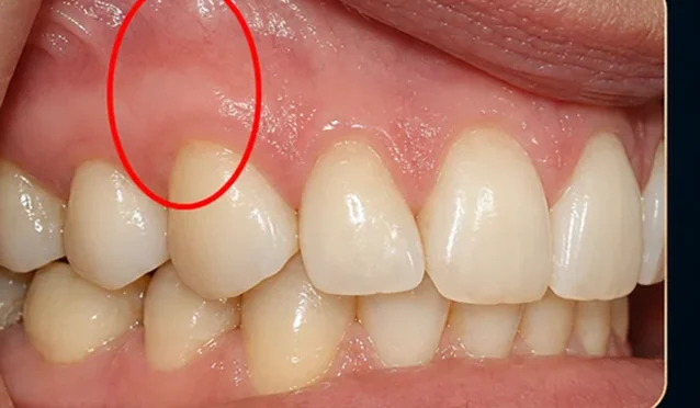 Gum recession — improved gum coverage — after
