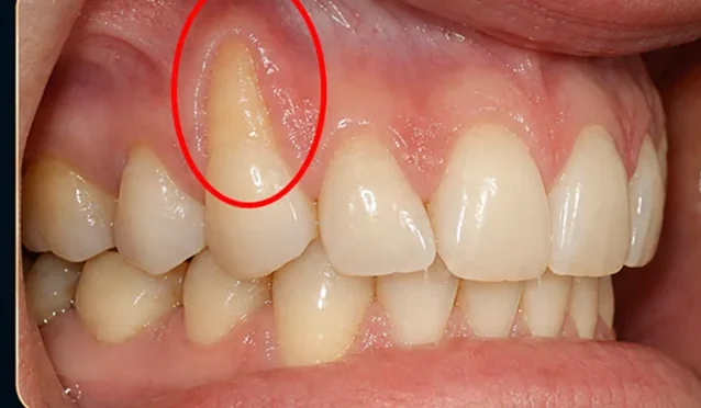 Gum recession — improved gum coverage — before
