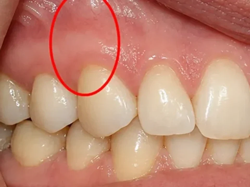 Gum recession — improved gum coverage — after