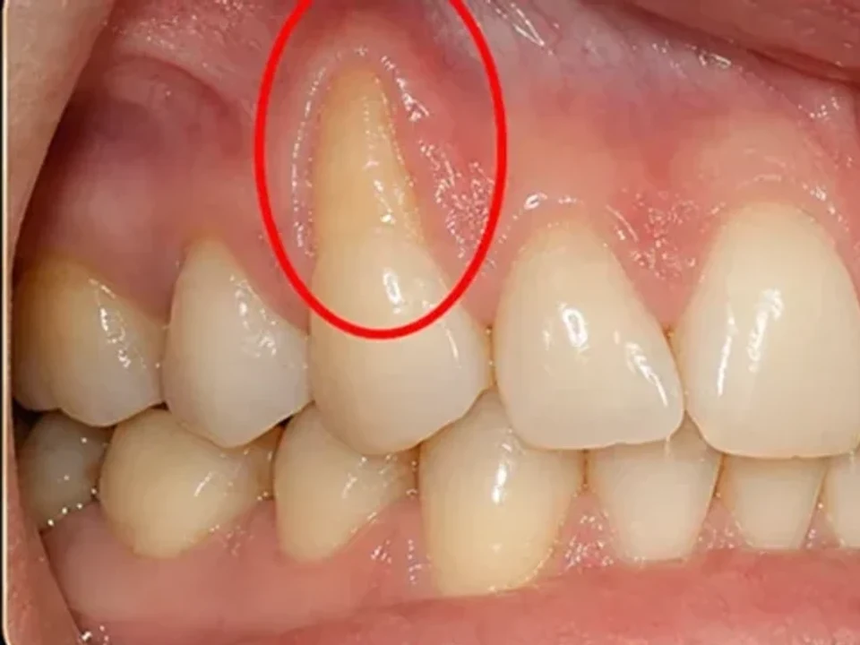 Gum recession — improved gum coverage — before