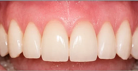 Gum recession and long-looking teeth treated with soft-tissue grafting — after