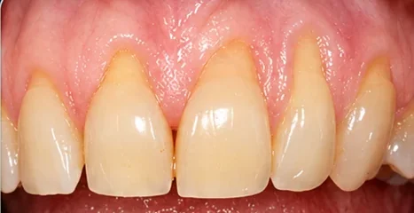 Gum recession and long-looking teeth treated with soft-tissue grafting — before