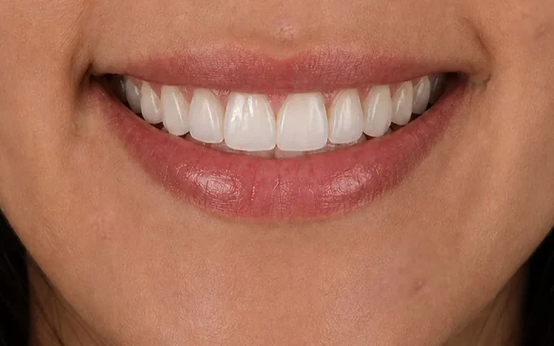 Gummy smile — before and after — after