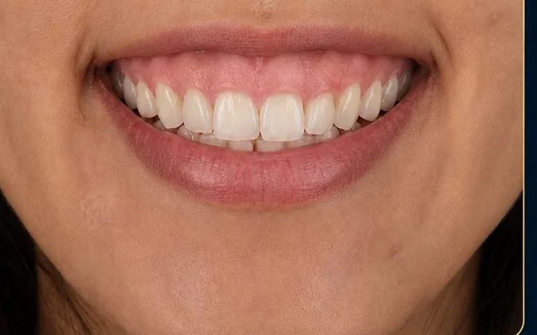 Gummy smile — before and after — before