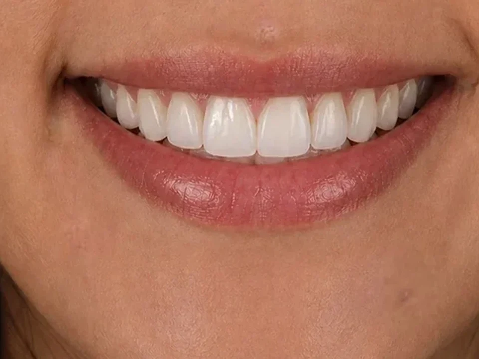 Gummy smile — before and after — after