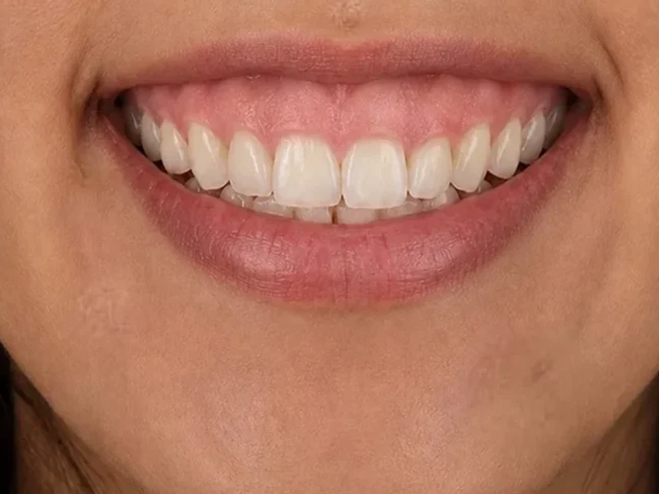 Gummy smile — before and after — before