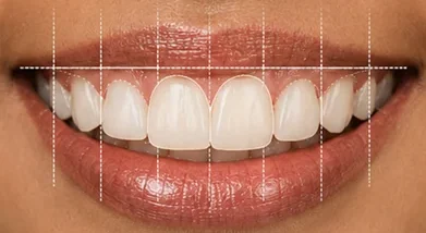 Excessive gummy smile — smile design & gum contouring — after