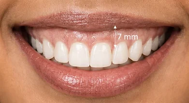 Excessive gummy smile — smile design & gum contouring — before