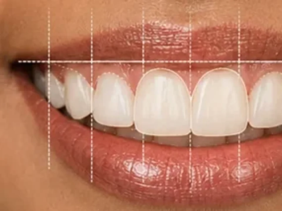 Excessive gummy smile — smile design & gum contouring — after