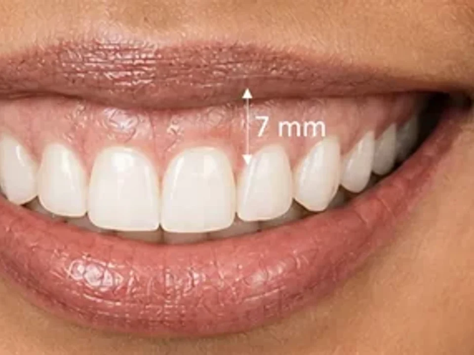 Excessive gummy smile — smile design & gum contouring — before
