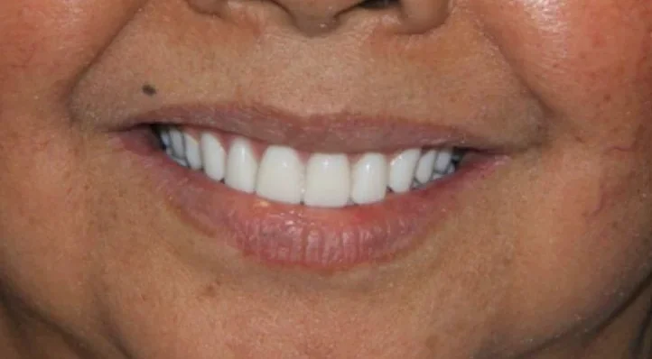 Changing faces with QDC implants — after