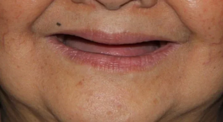 Changing faces with QDC implants — before