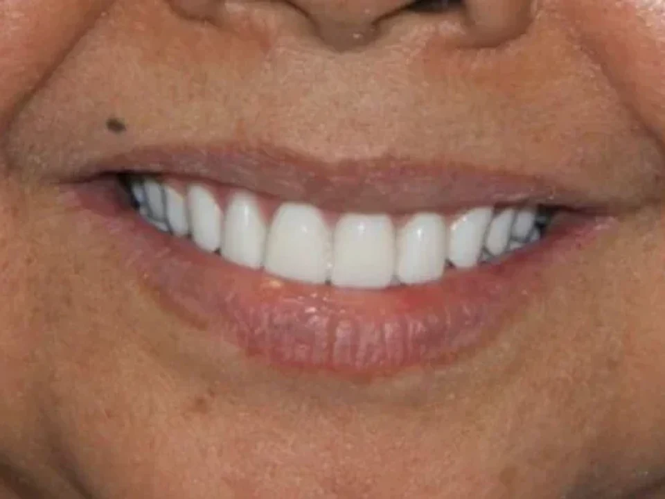 Changing faces with QDC implants — after