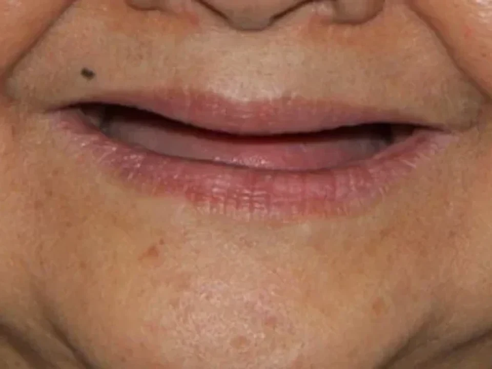Changing faces with QDC implants — before
