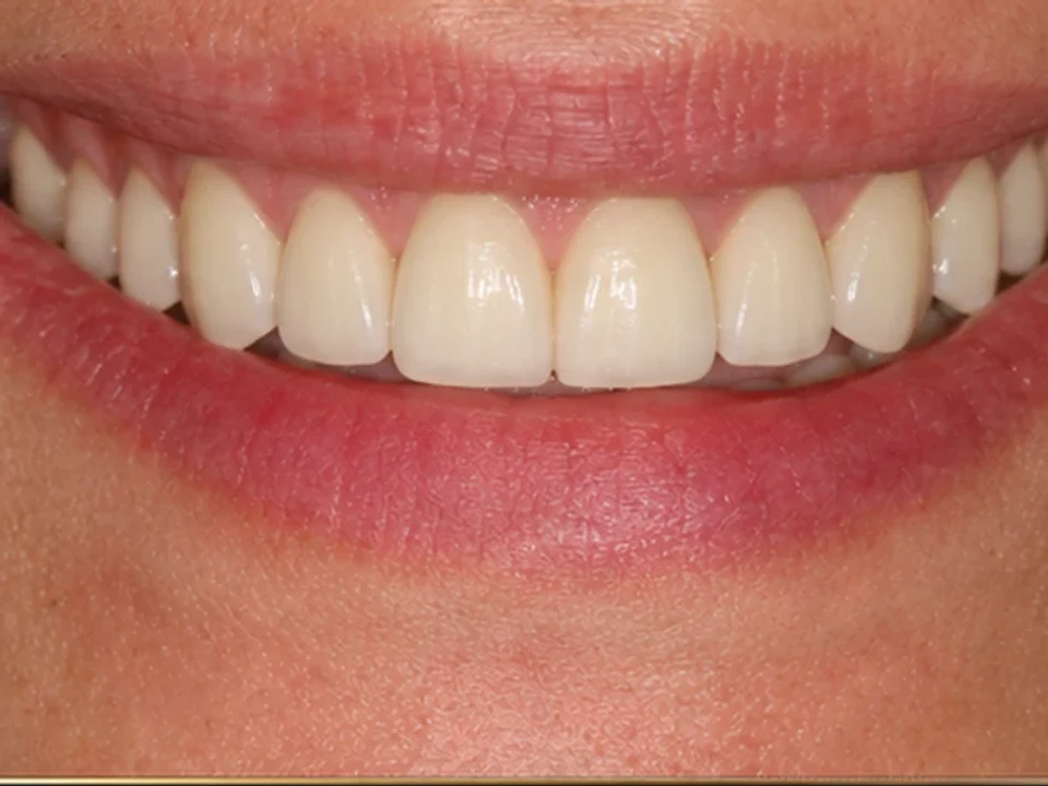 Exposed implant fixtures restored to a full natural smile — after