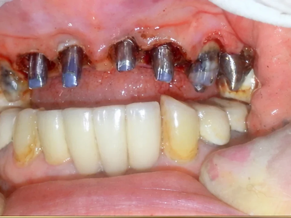 Exposed implant fixtures restored to a full natural smile — before