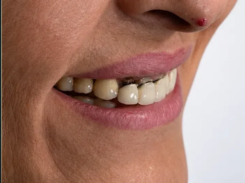 The art of full-arch transformation — before