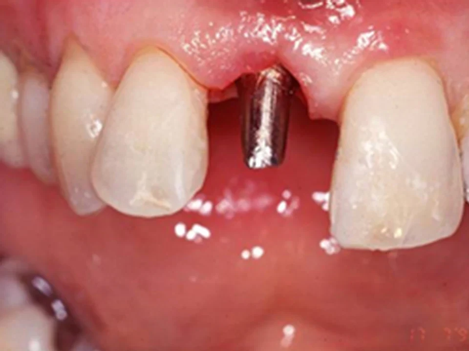 Miracle smiles through implants at The QDC — before