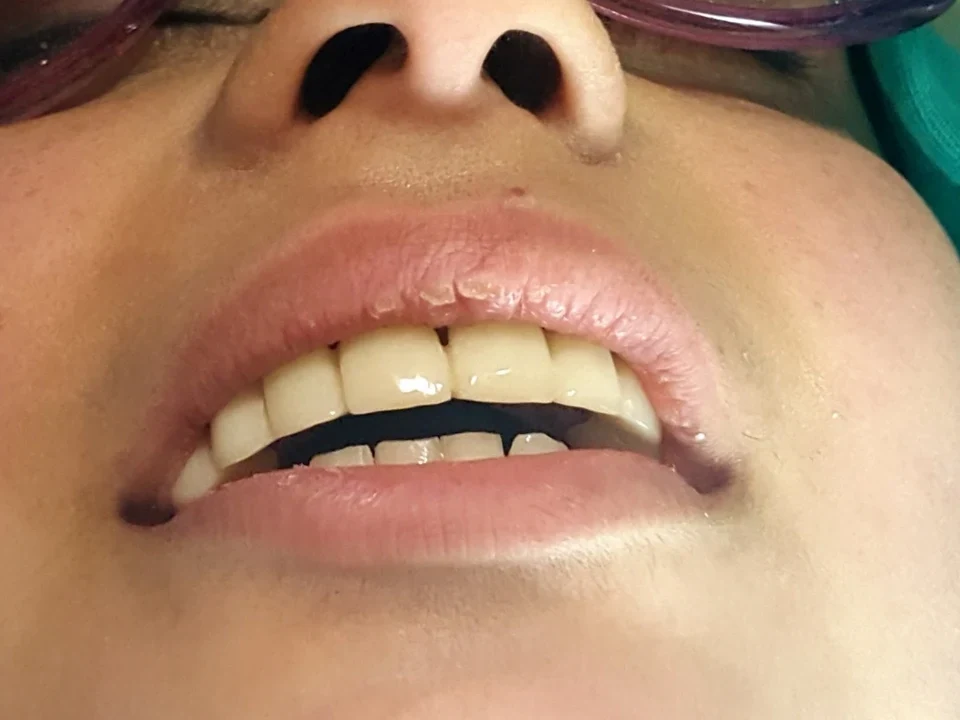 Implant smile transformation — after