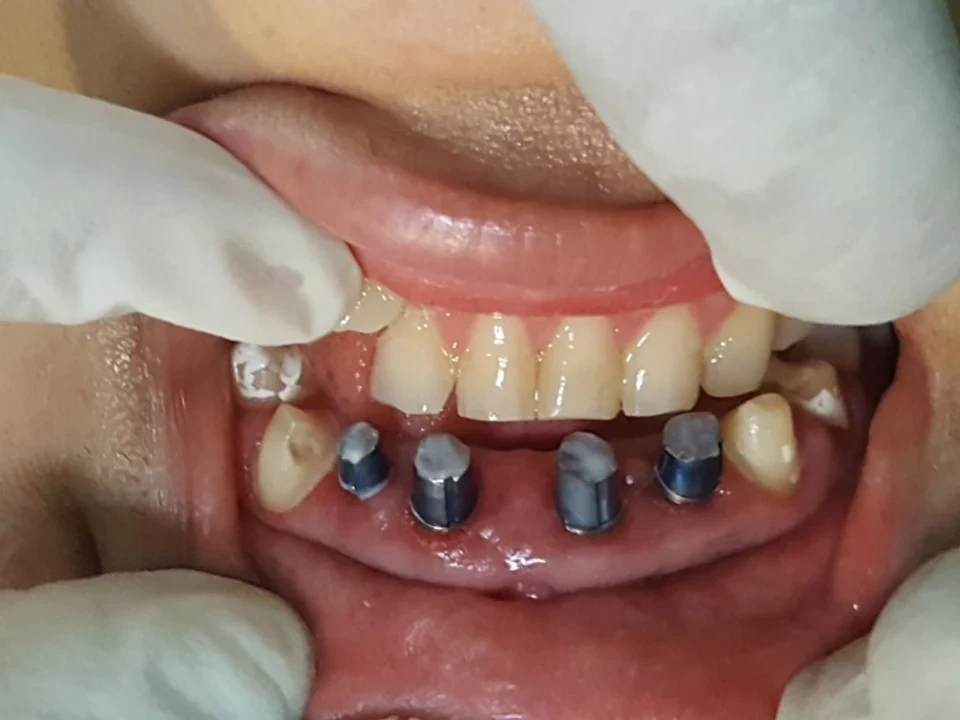 Implant smile transformation — before