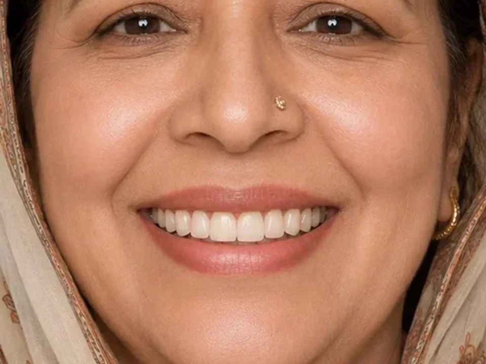 Multiple implants — facial rehabilitation — after