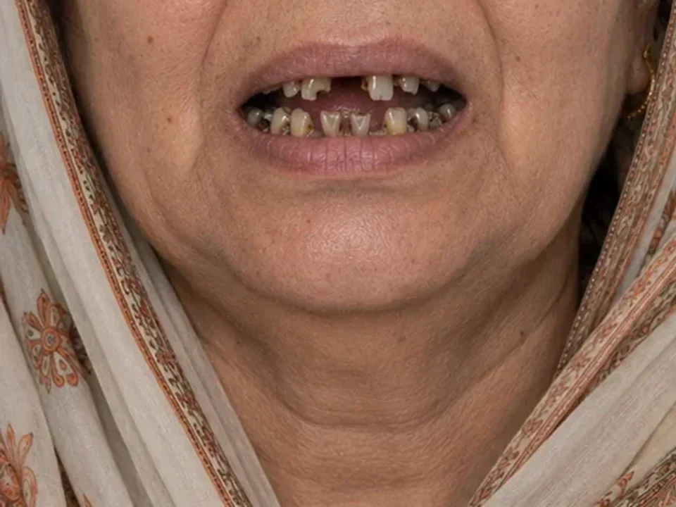 Multiple implants — facial rehabilitation — before