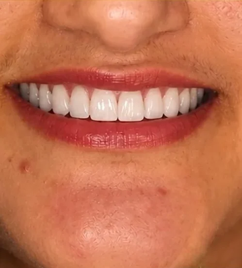 Multiple implants — smile restored — after